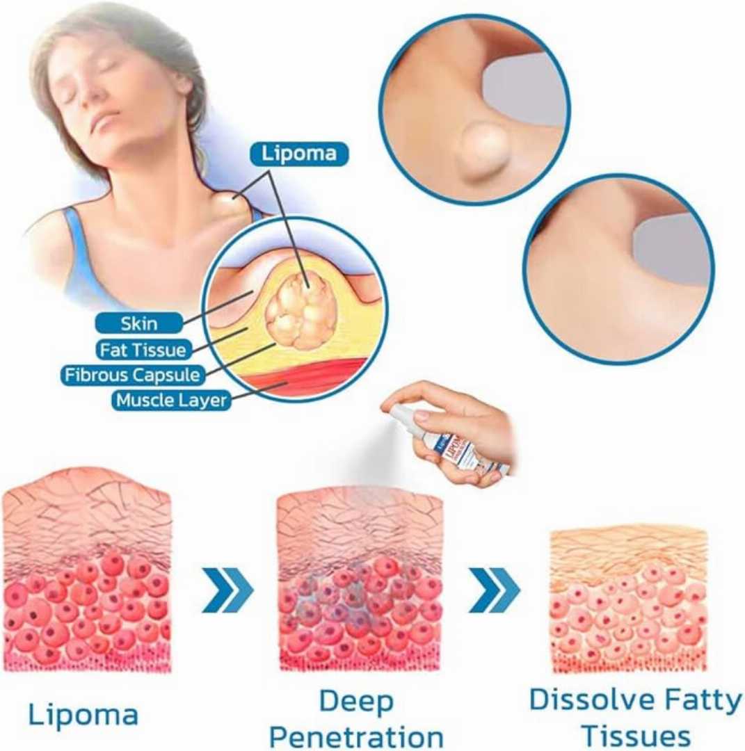 South,Moon,Lipoma,Remover,Spray,Relief,Lipolysis,Fat,Lump,With,Lipoma,Spray,50,ml