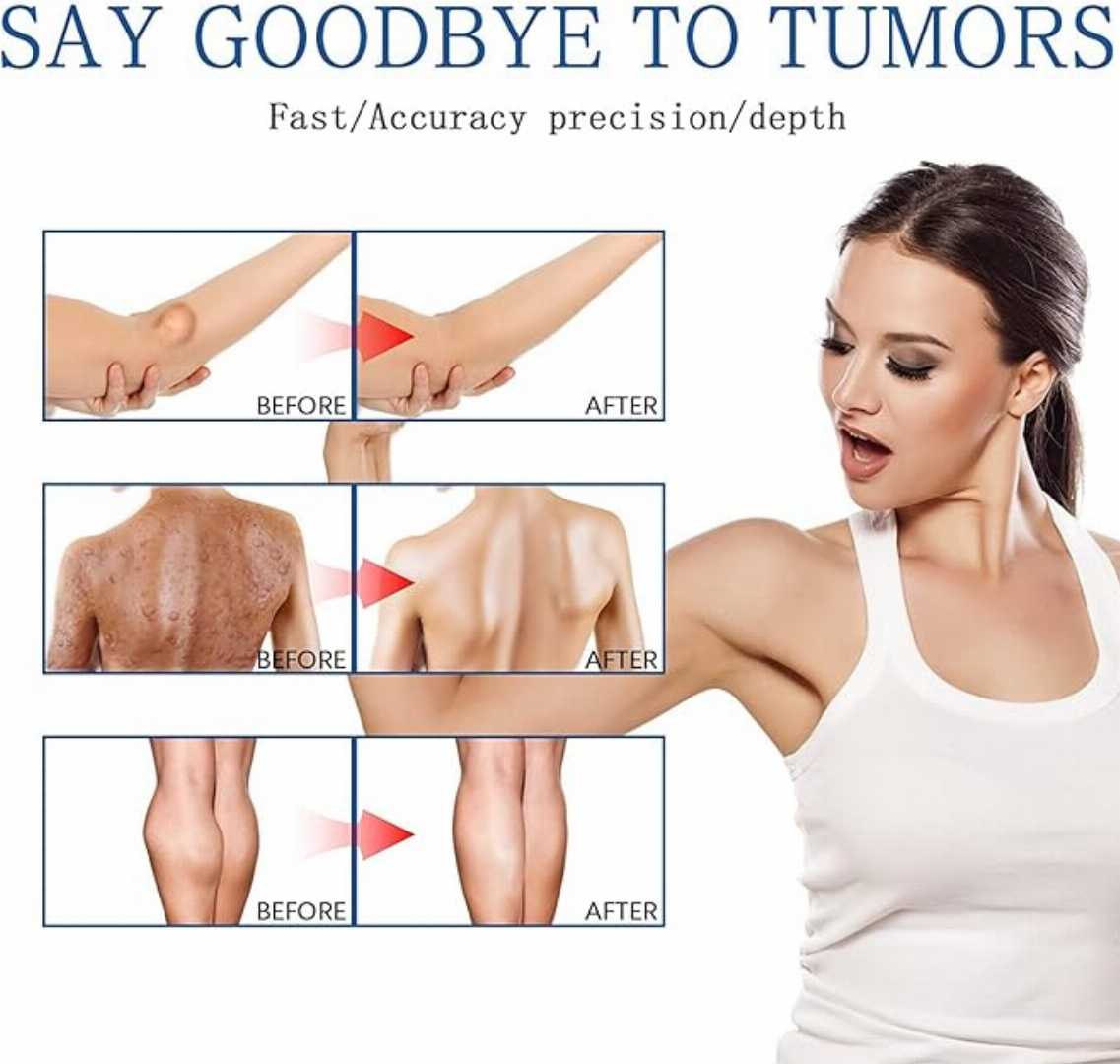 South,Moon,Lipoma,Remover,Spray,Relief,Lipolysis,Fat,Lump,With,Lipoma,Spray,50,ml